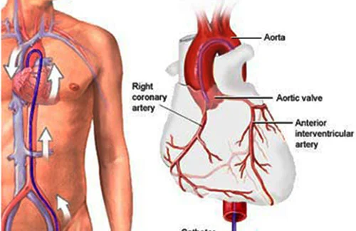 Coronary-angiography-dr-arun-kumar-gupta