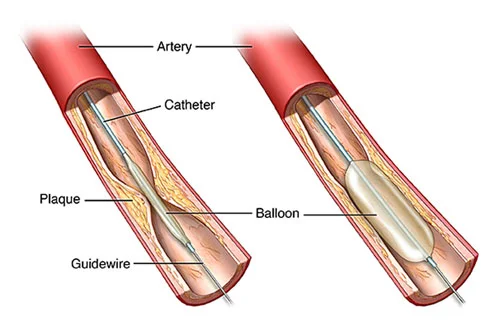 Coronary-angiopalsty-dr-arun-kumar-gupta